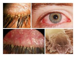 síntomas de la presencia de parásitos debajo de la piel humana